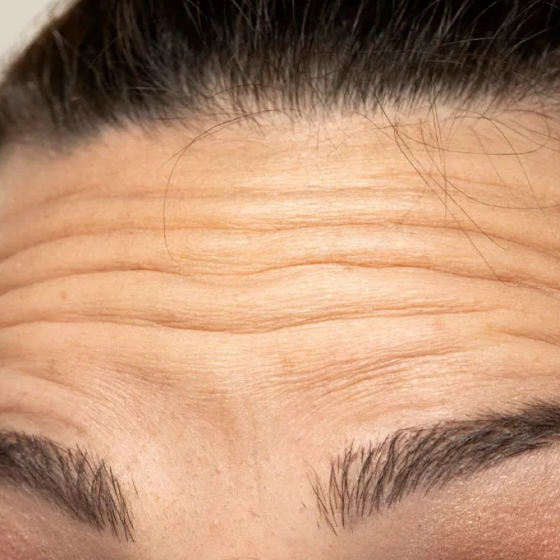 FOREHEAD - QL Clinic by Qulit